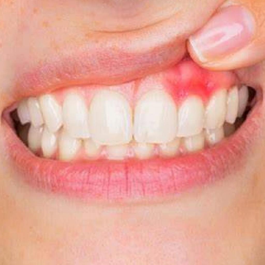 Does gum disease go away?