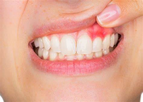 Does gum disease go away?