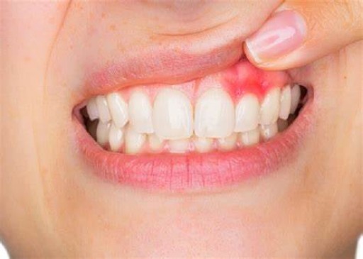 Does gum disease go away