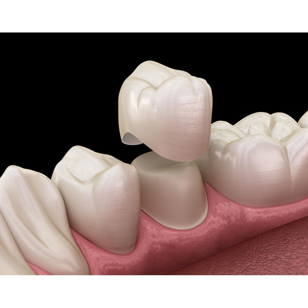 What is a tooth crown?