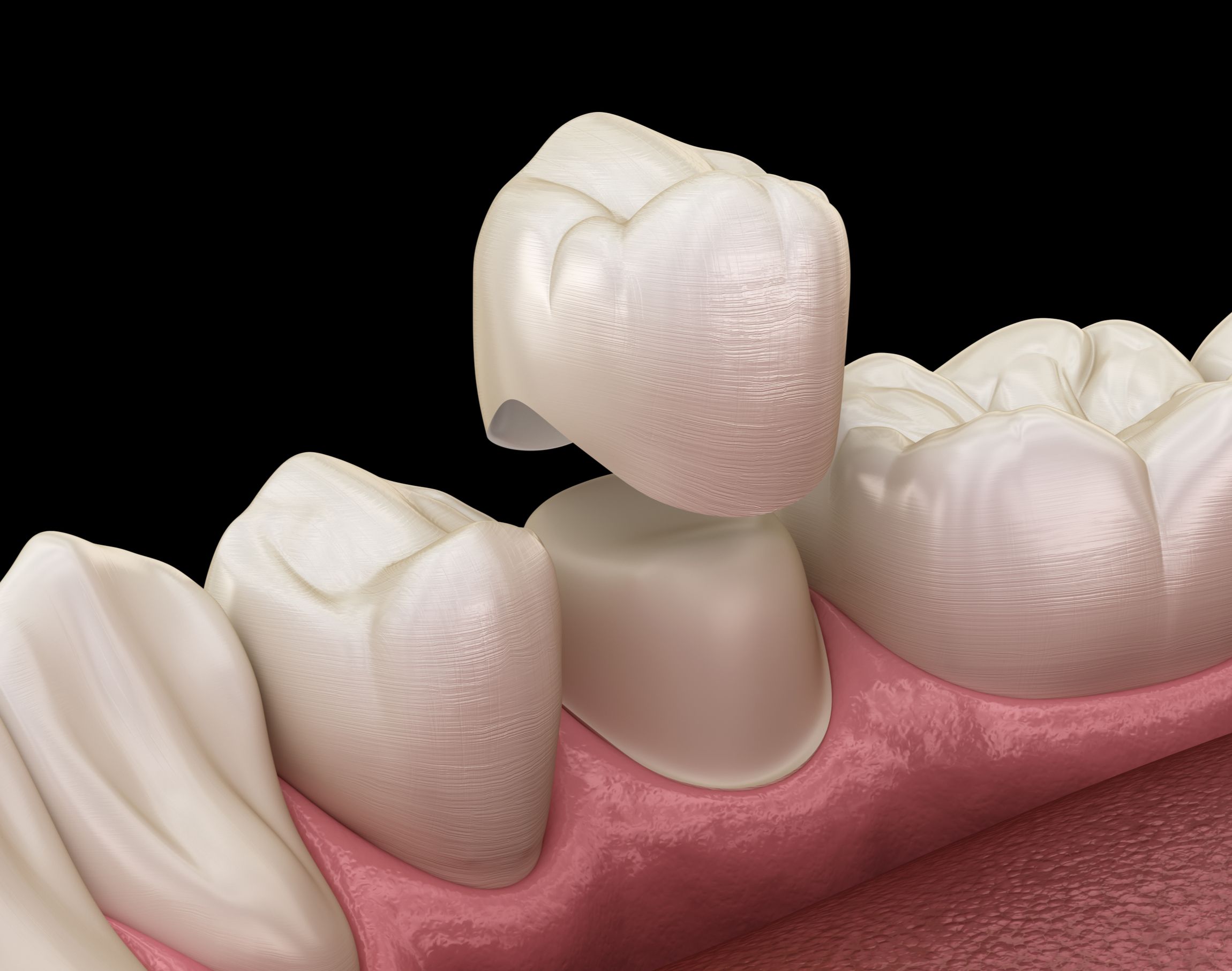 What is a tooth crown?