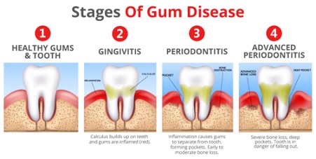 Stages-of-gum-disease.jpg