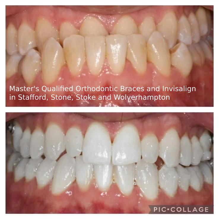 Masters-Qualified-Orthodontic-Braces (1).jpg