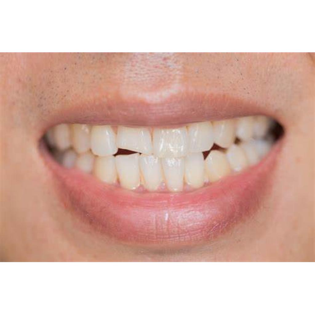 How to repair Chipped teeth