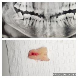 Impacted Wisdom Tooth Removal at Church Lane