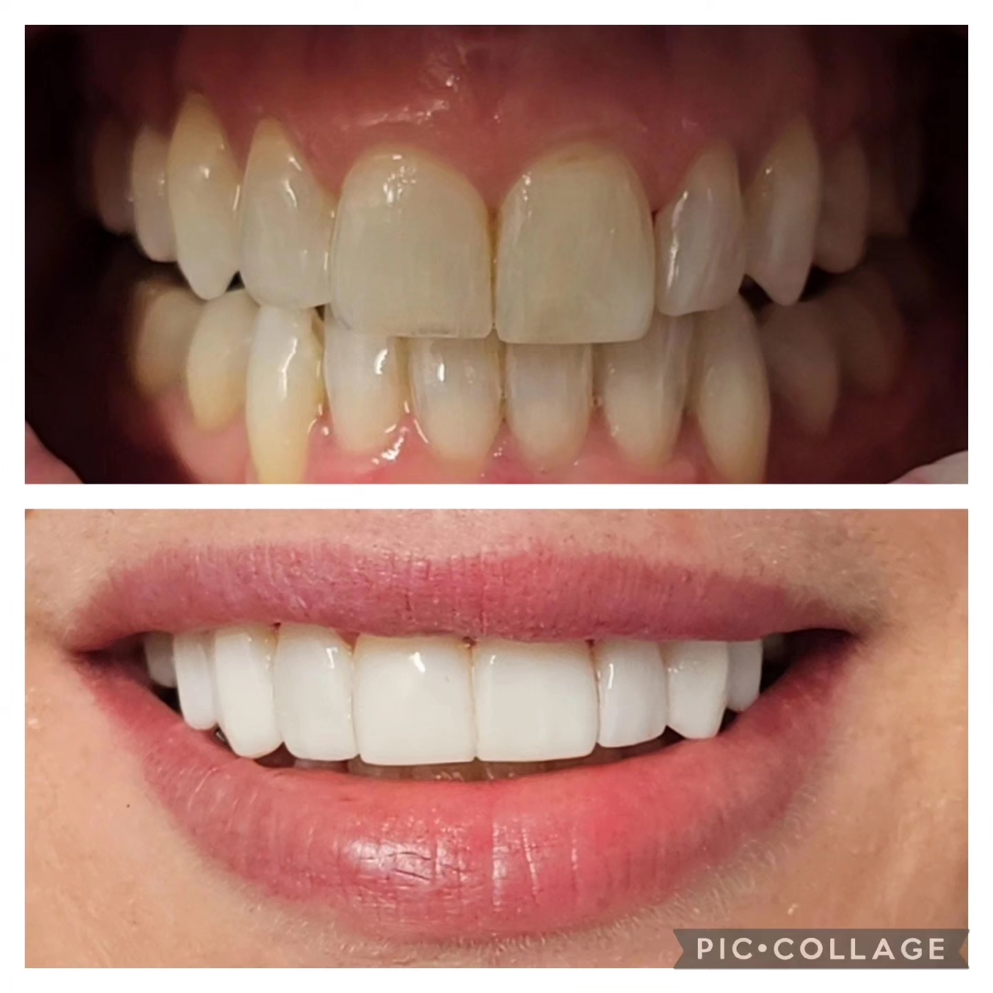 Teeth Whitening in Stafford