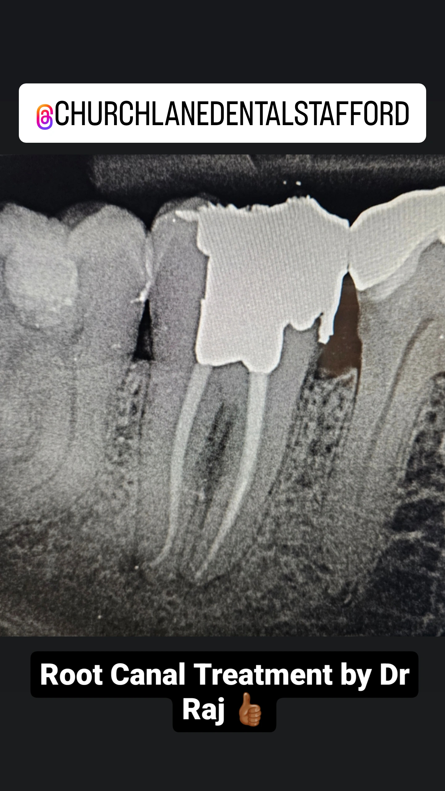 Root Canal Image.jpg