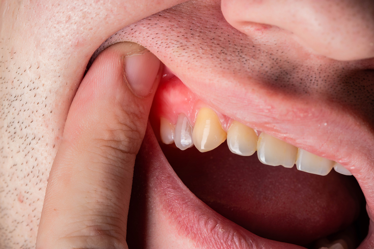 Can Gums Recover from Gum Disease?