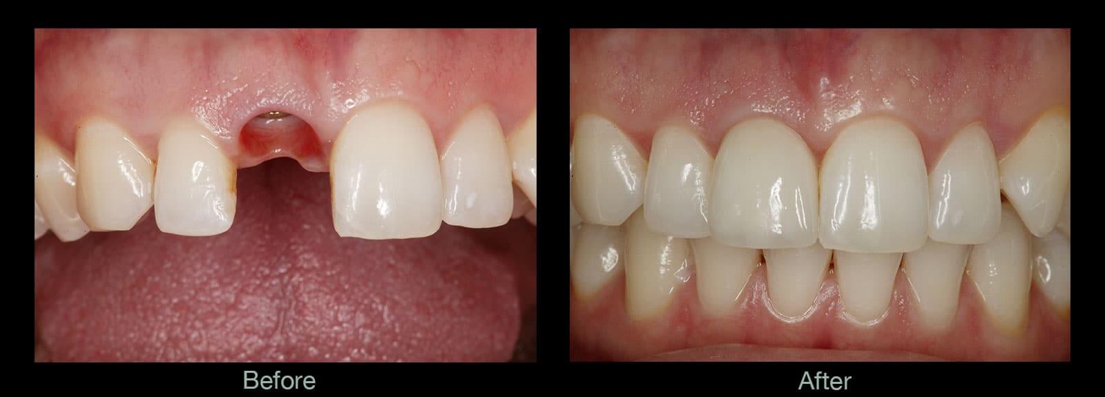 Dental-Implants-Before-After-Pictures.jpg