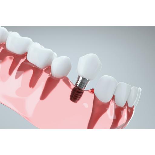 dental implant Stafford