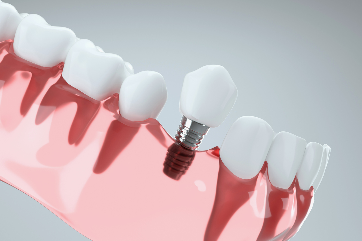 A Few Popular FAQs on Dental Implants