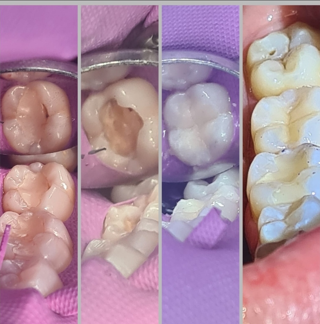 White Fillings at Church Lane Dental