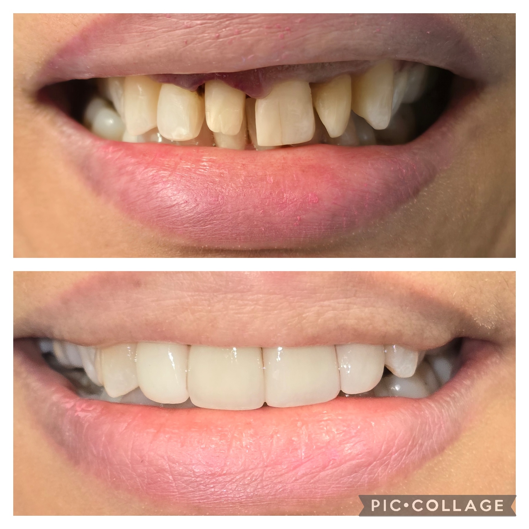 3 Veneers and 1 Crown to Transform the Smile