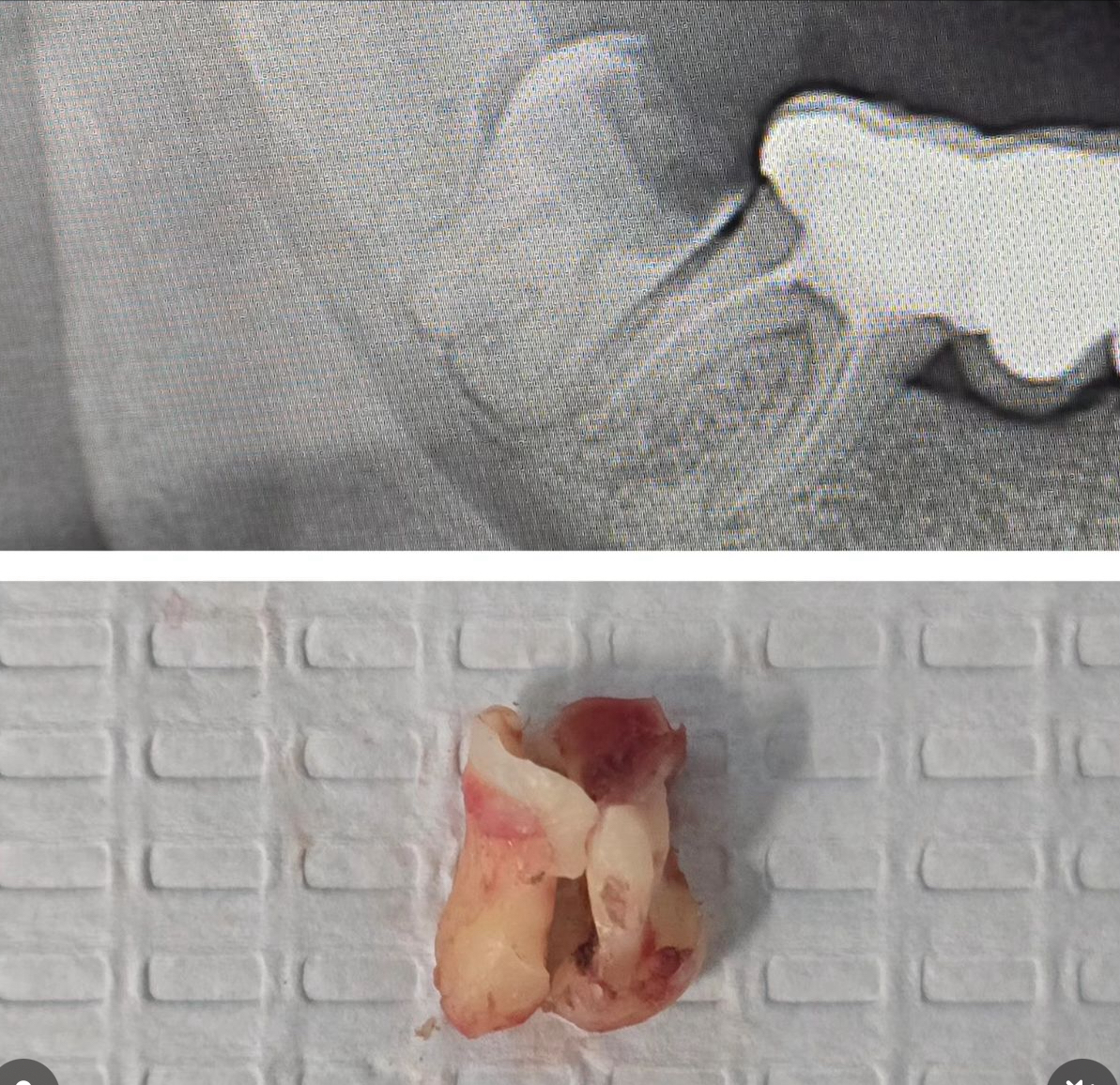 Impacted Carious Bulbous Wisdom Tooth Removal