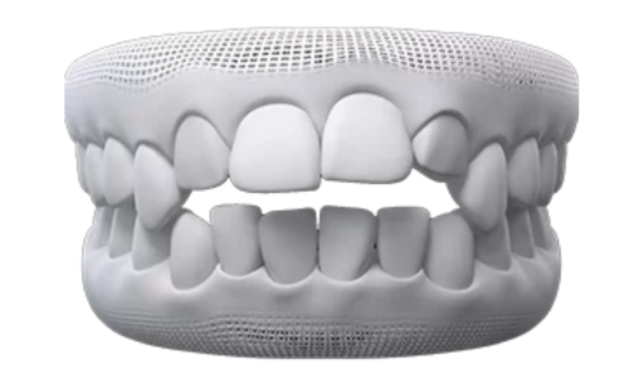 what can invisalign fix - open bite.png